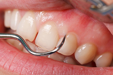 Gums-2015-Dra-Emma-Periodoncia-Mexicali 