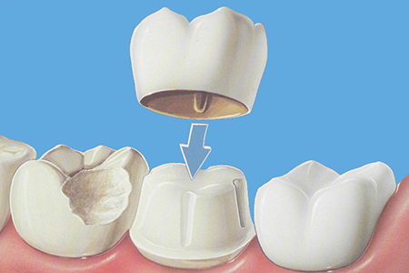 Coronas-2015-Dra-Emma-Periodoncia-Mexicali 